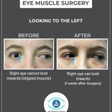 _Eye Muscle Surgery Sydney